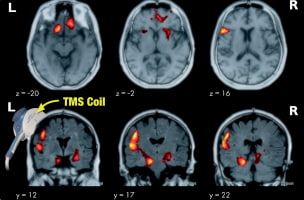 TMS Therapy Fact Sheet