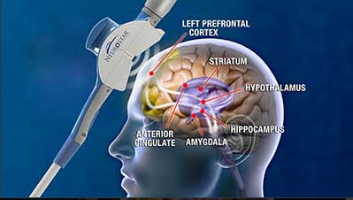 Transcranial Magnetic Stimulation Offers Hope for Treatment-Resistant Depression