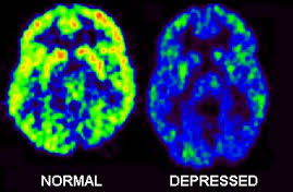 Magnetic Stimulation Eases Treatment-Resistant Depression